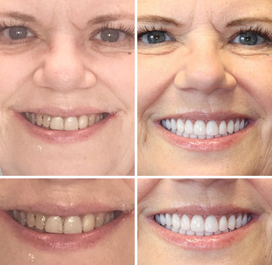 HOOMWELL™ --🦷Advanced Customized Full Denture Set🦷 (⏰Limited time discount last 30 minutes⏰)