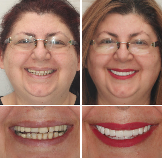 HOOMWELL™ --🦷Advanced Customized Full Denture Set🦷 (⏰Limited time discount last 30 minutes⏰)
