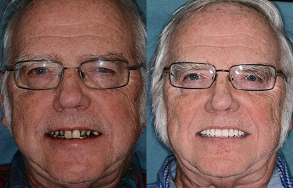 HOOMWELL™ --🦷Advanced Customized Full Denture Set🦷 (⏰Limited time discount last 30 minutes⏰)