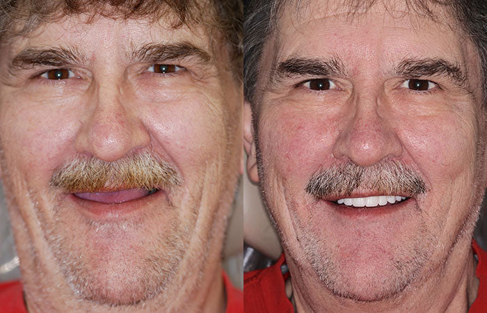 HOOMWELL™ --🦷Advanced Customized Full Denture Set🦷 (⏰Limited time discount last 30 minutes⏰)