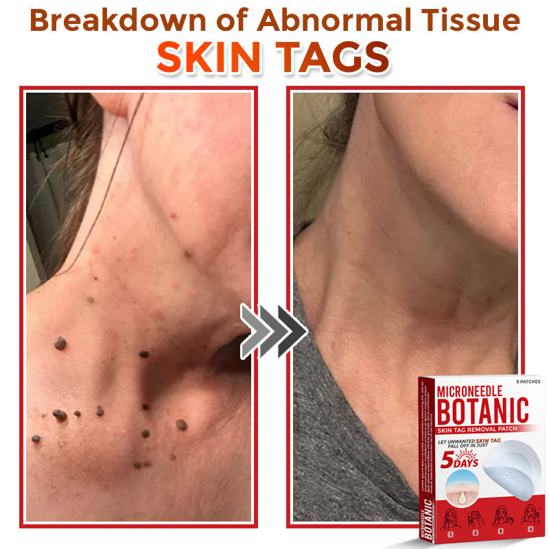 Microneedle Botanical Skin Tag Removal Patch 🇺🇸Made in the USA (FDA Certified)