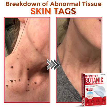 Microneedle Botanical Skin Tag Removal Patch 🇺🇸Made in the USA (FDA Certified)