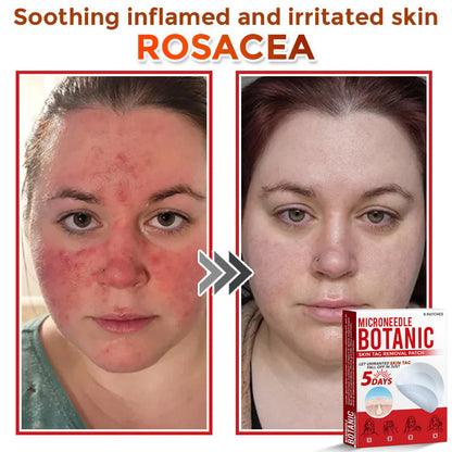 Microneedle Botanical Skin Tag Removal Patch 🇺🇸Made in the USA (FDA Certified)