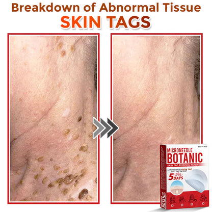 Microneedle Botanical Skin Tag Removal Patch 🇺🇸Made in the USA (FDA Certified)