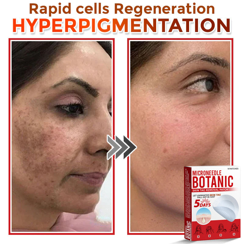 Microneedle Botanical Skin Tag Removal Patch 🇺🇸Made in the USA (FDA Certified)