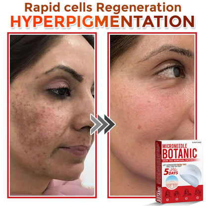 Microneedle Botanical Skin Tag Removal Patch 🇺🇸Made in the USA (FDA Certified)