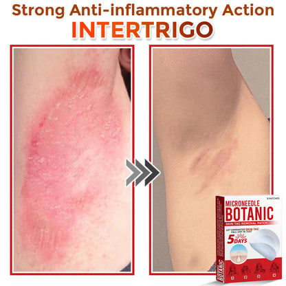 Microneedle Botanical Skin Tag Removal Patch 🇺🇸Made in the USA (FDA Certified)