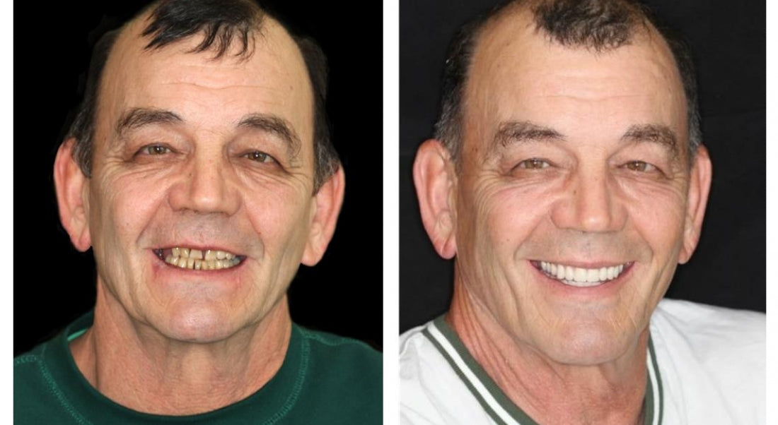 HOOMWELL™ --🦷Advanced Customized Full Denture Set🦷 (⏰Limited time discount last 30 minutes⏰)