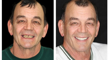 HOOMWELL™ --🦷Advanced Customized Full Denture Set🦷 (⏰Limited time discount last 30 minutes⏰)