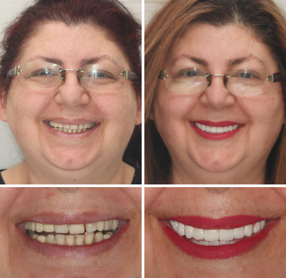 HOOMWELL™ --🦷Advanced Customized Full Denture Set🦷 (⏰Limited time discount last 30 minutes⏰)