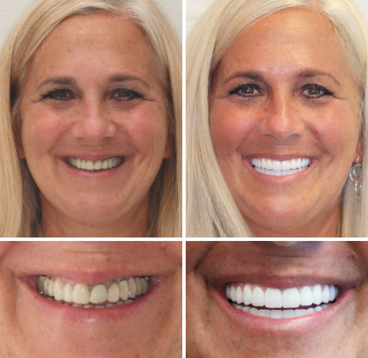 HOOMWELL™ --🦷Advanced Customized Full Denture Set🦷 (⏰Limited time discount last 30 minutes⏰)