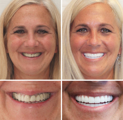 HOOMWELL™ --🦷Advanced Customized Full Denture Set🦷 (⏰Limited time discount last 30 minutes⏰)